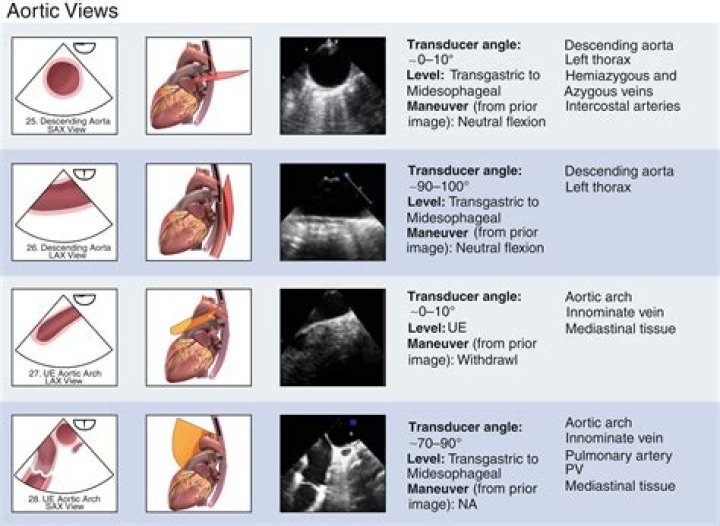 Are you awake for transesophageal echocardiogram?