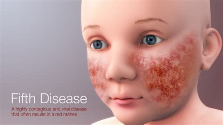 Can adults get fifths disease again?