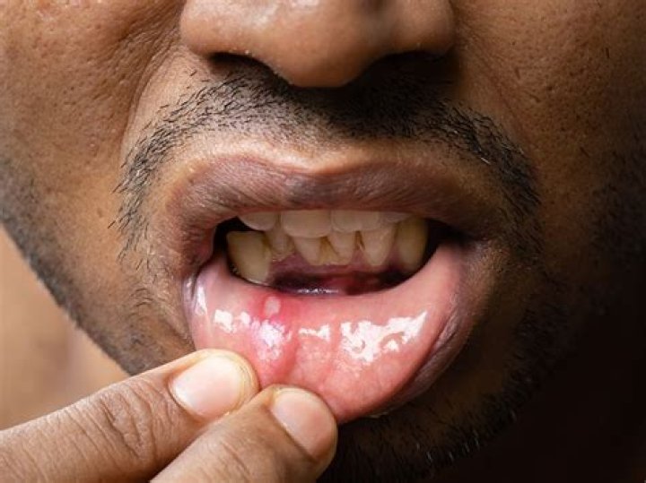 Can hydrochlorothiazide cause mouth sores?