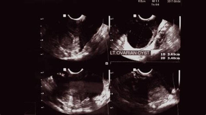 Can ovarian cysts affect unborn baby?