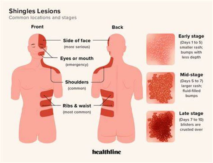 Can shingles affect your urine?