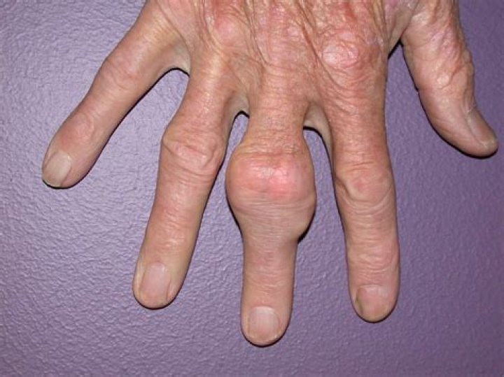 Can tophi be removed surgically?