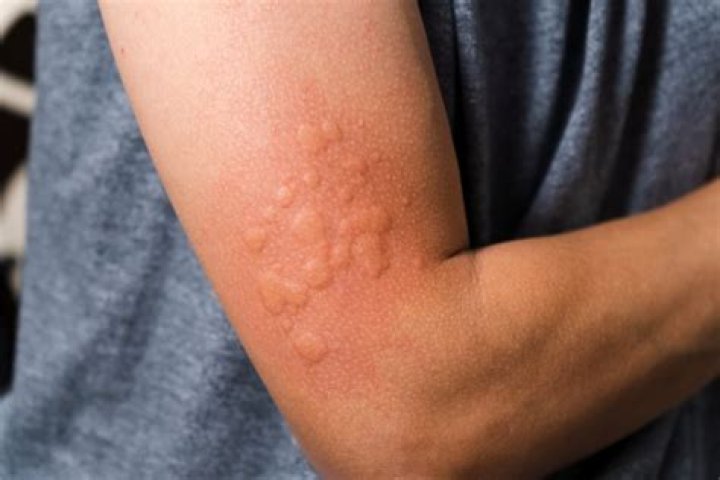 Can you be allergic to latex tape?