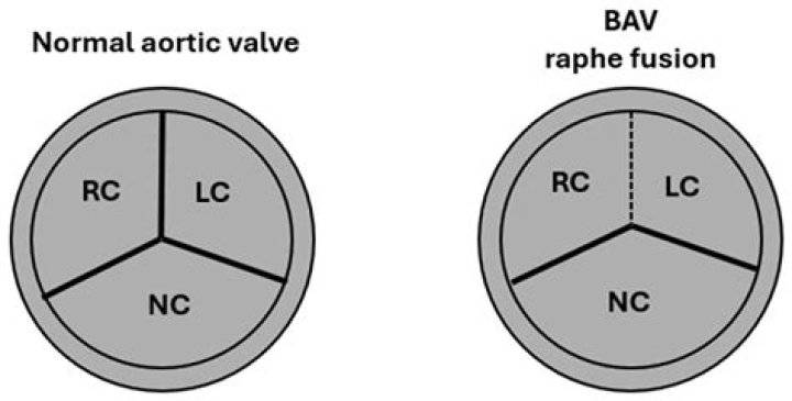 Can you live a normal life with a bicuspid aortic valve?