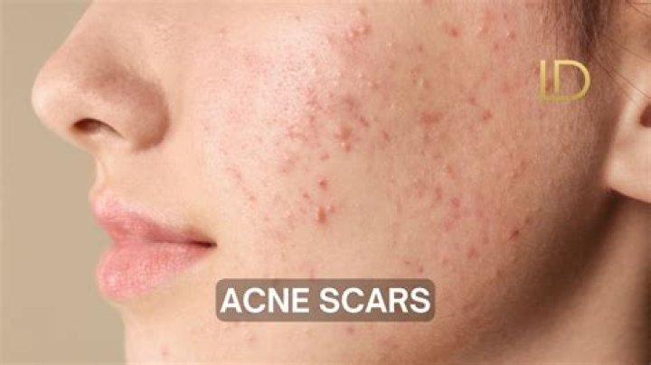Do mild acne scars go away?