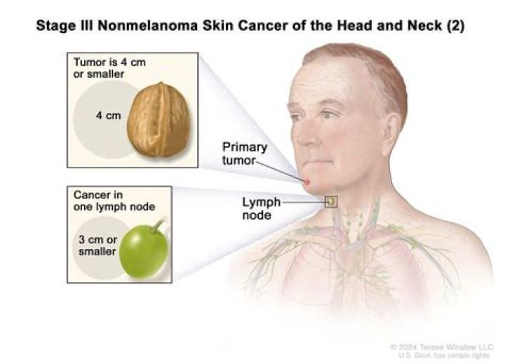 Does cancer under chin hurt?