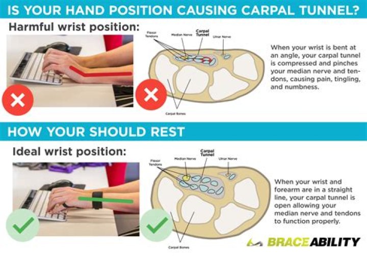 Does carpal tunnel cause itching?