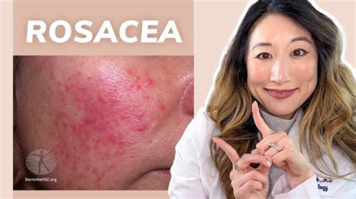 Does cleansing help with rosacea?