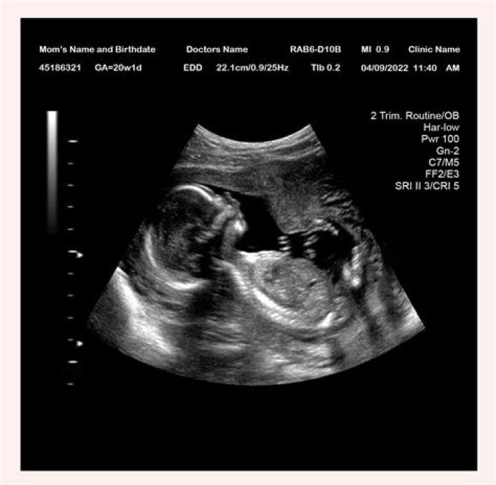 How accurate are 19 week ultrasounds at determining gender?