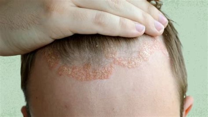 How can I clear my scalp at home?