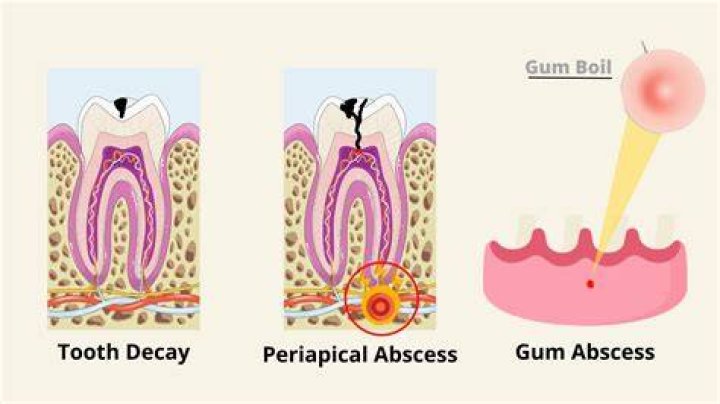 How can you tell the difference between an abscess and laminitis?