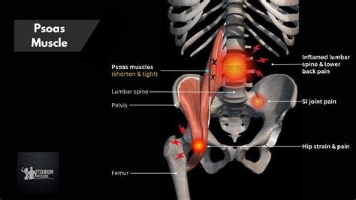 How do you treat a torn psoas muscle?