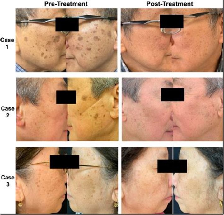 How does apple cider vinegar get rid of seborrheic keratosis?