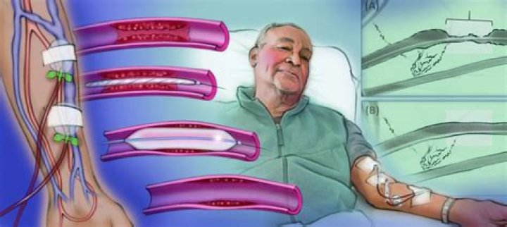 How is a dialysis catheter infection treated?