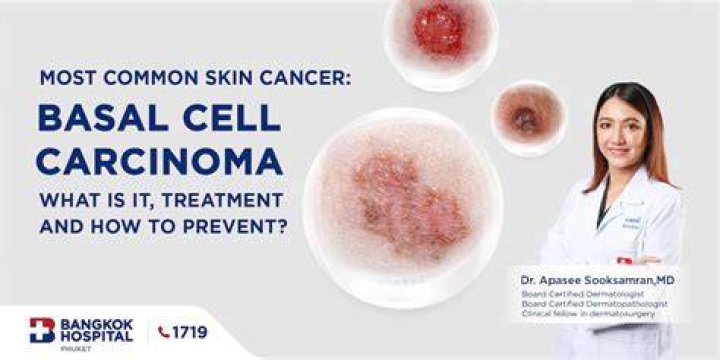 How much does it cost to remove a basal cell?