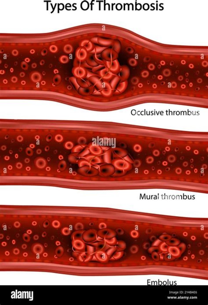 Is a mural thrombus a blood clot?