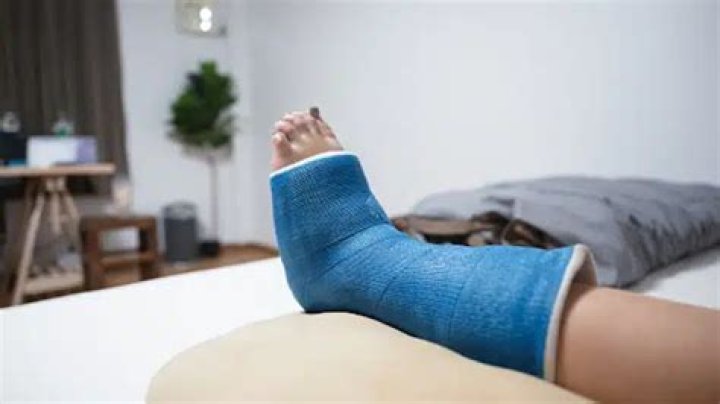 Is casting included in fracture care?