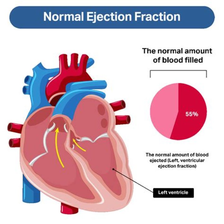 Is ejection fraction affected by preload?