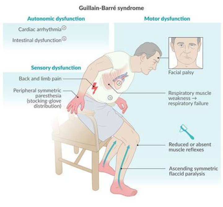 Is Guillain Barre ascending or descending?