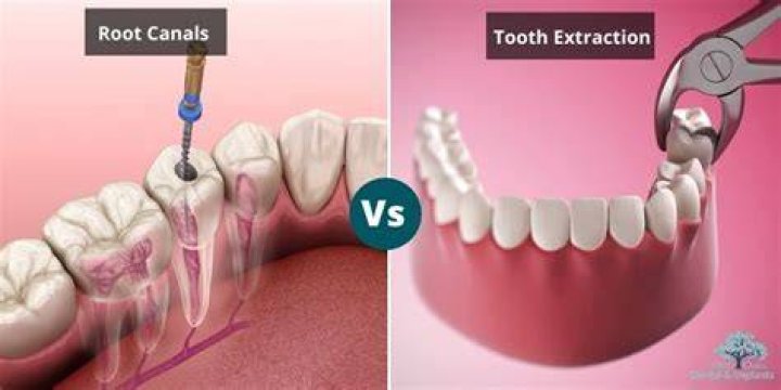 Is it painful to extract a root canal tooth?
