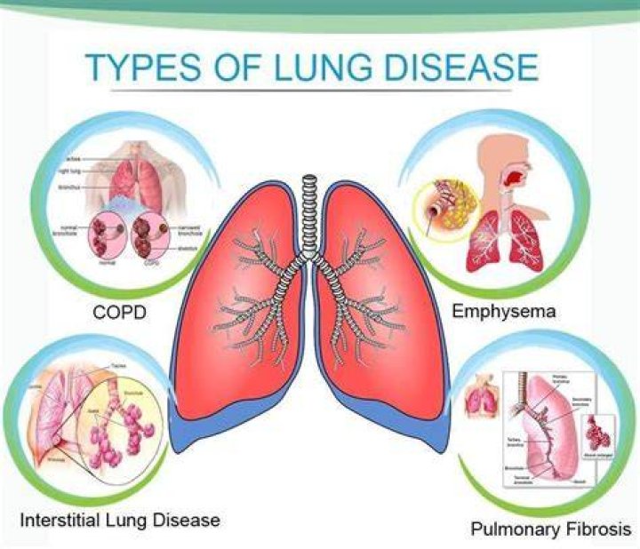What are the top 5 lung diseases?