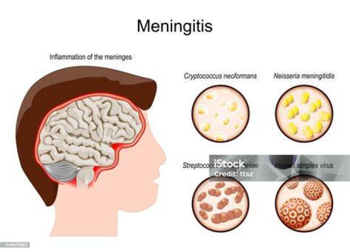 What causes Cryptococcus meningitis?