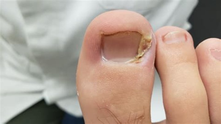 What causes hangnails on toes?