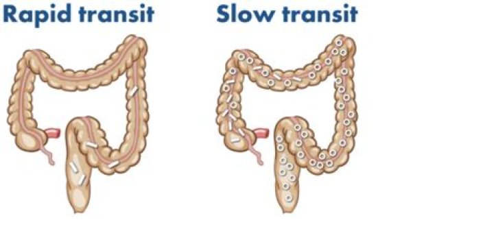 What causes rapid intestinal transit?