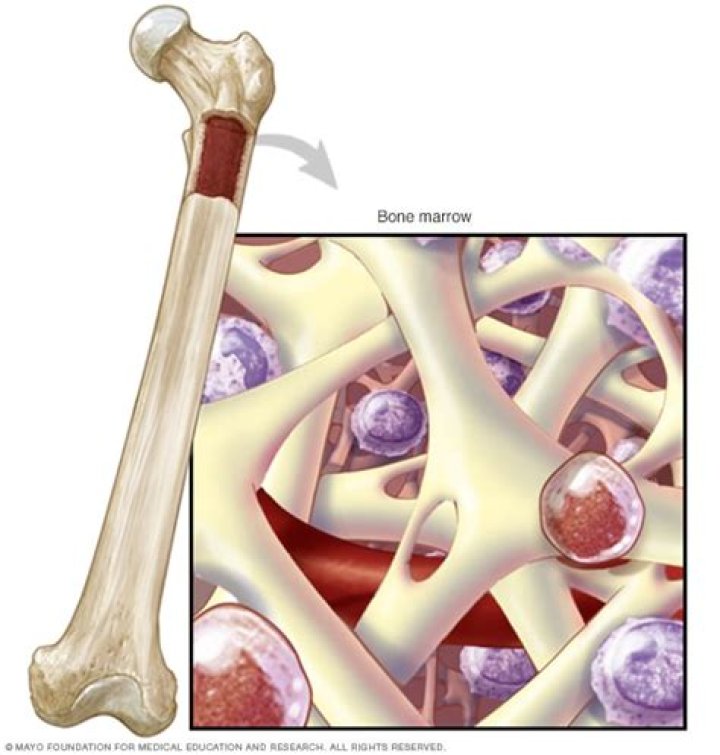 What happens when bone marrow leaks into the bloodstream?
