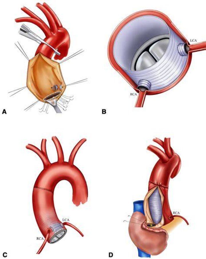 What is a Cabrol procedure?