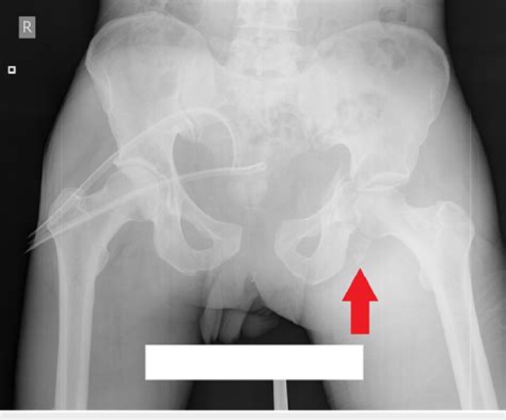 What is a closed reduction of the hip?