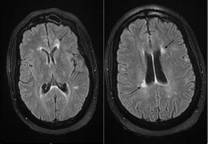 What is a demyelinating lesion?