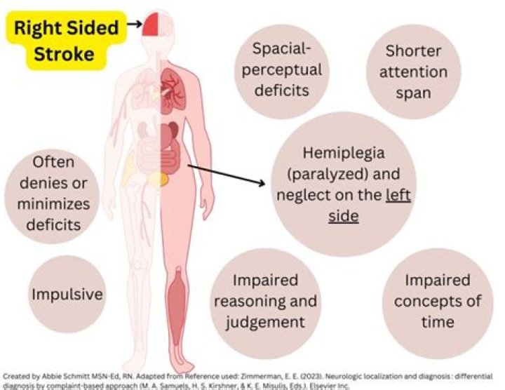 What is a right sided hemiplegia?