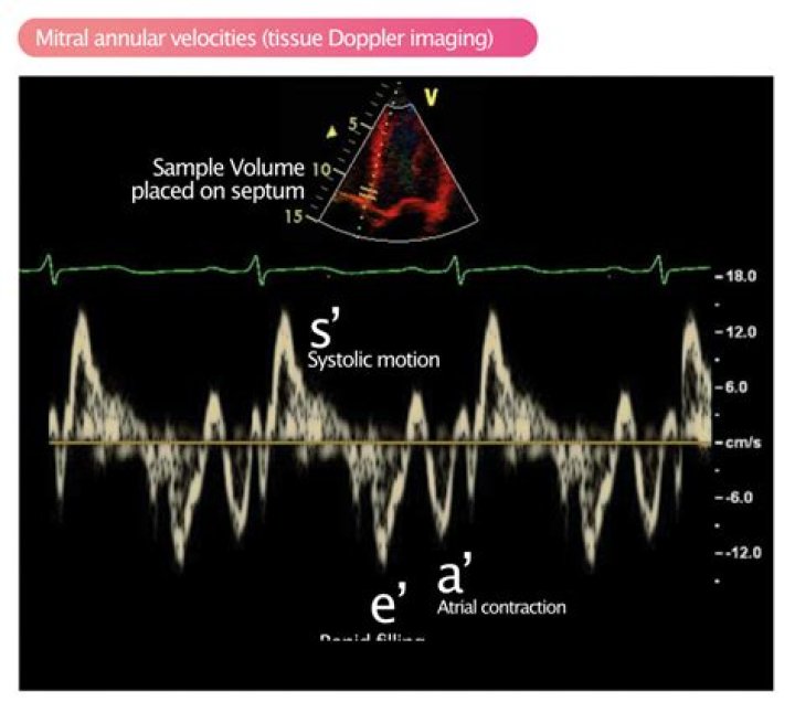 What is early diastolic mitral annular velocity?
