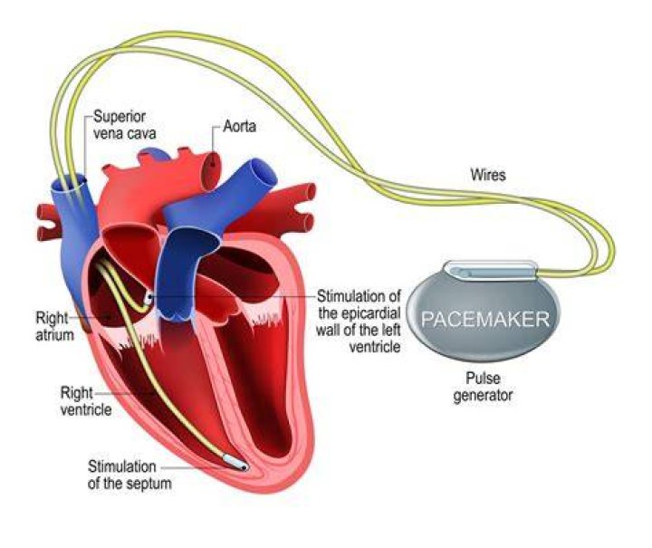 What is mode of pacemaker?