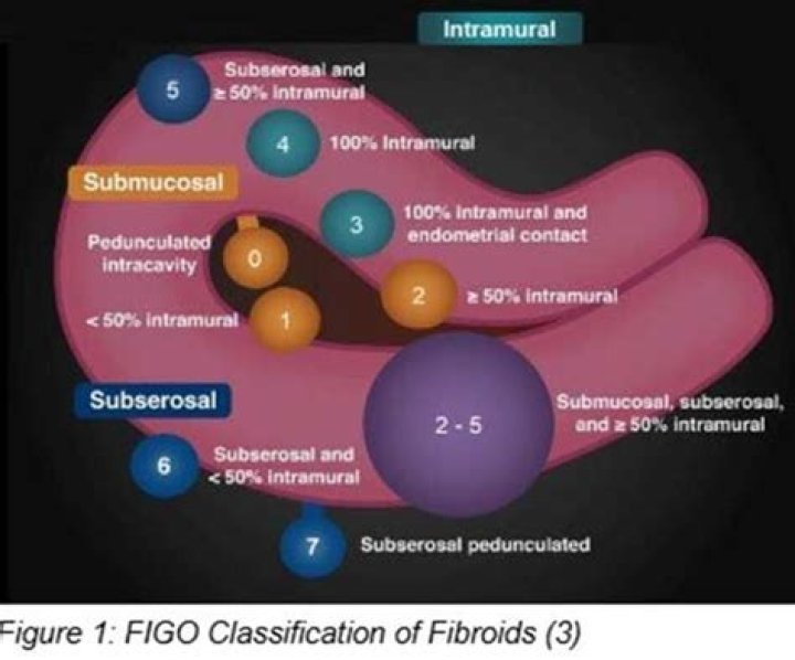 What is the diagnosis code for fibroids?