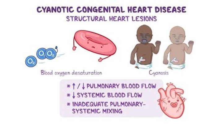 What is the most common cyanotic congenital cardiac defect in neonates?