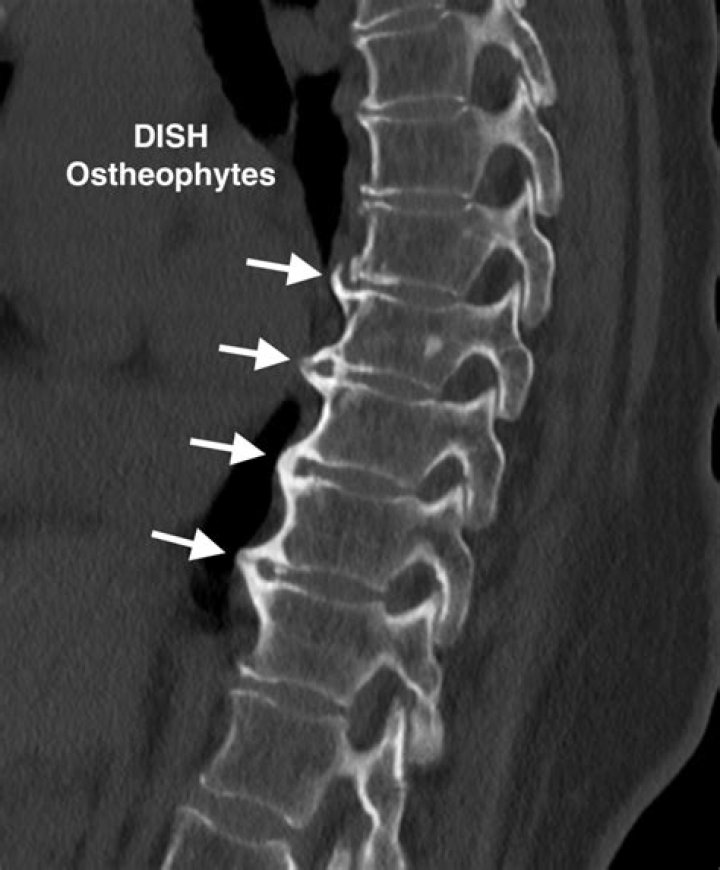 What is vertebral osteochondrosis?
