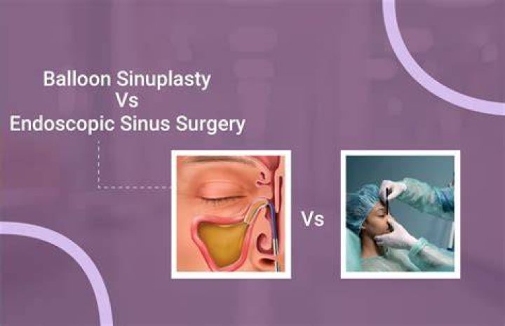 When do you do balloon sinuplasty?