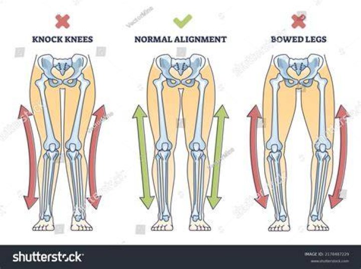 Which of the following can increase the severity of genu Valgum?